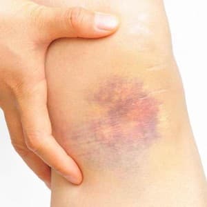 bruise