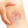 bruise