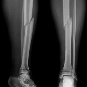 fracture