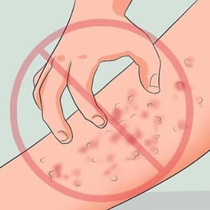 rash