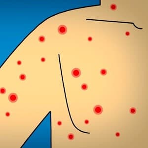 smallpox